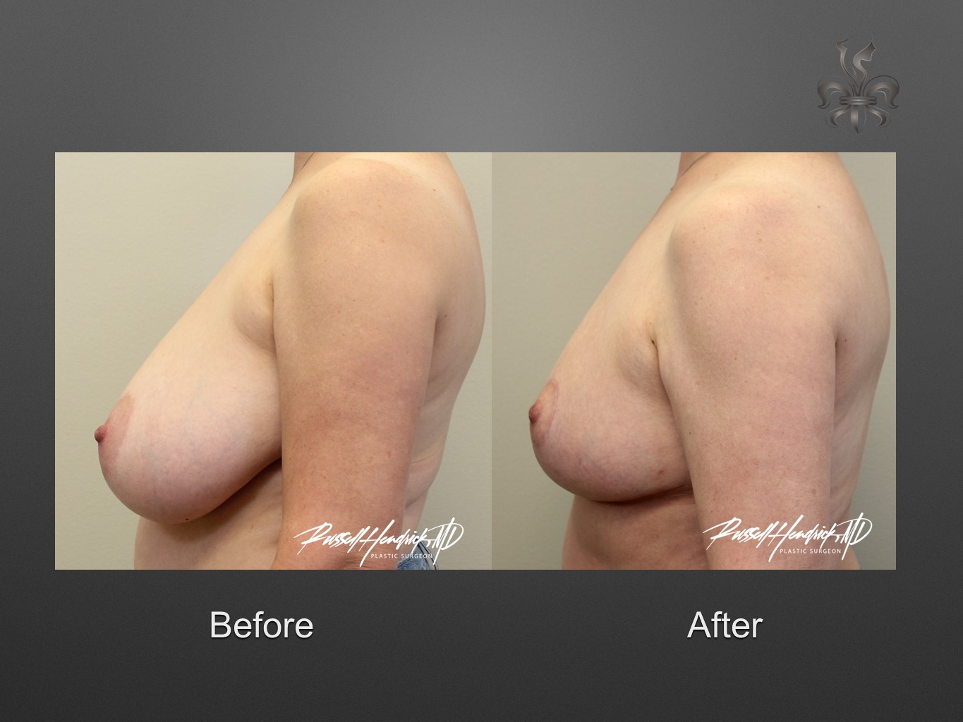breast reduction before and after