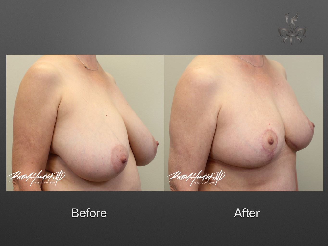 breast reduction before and after