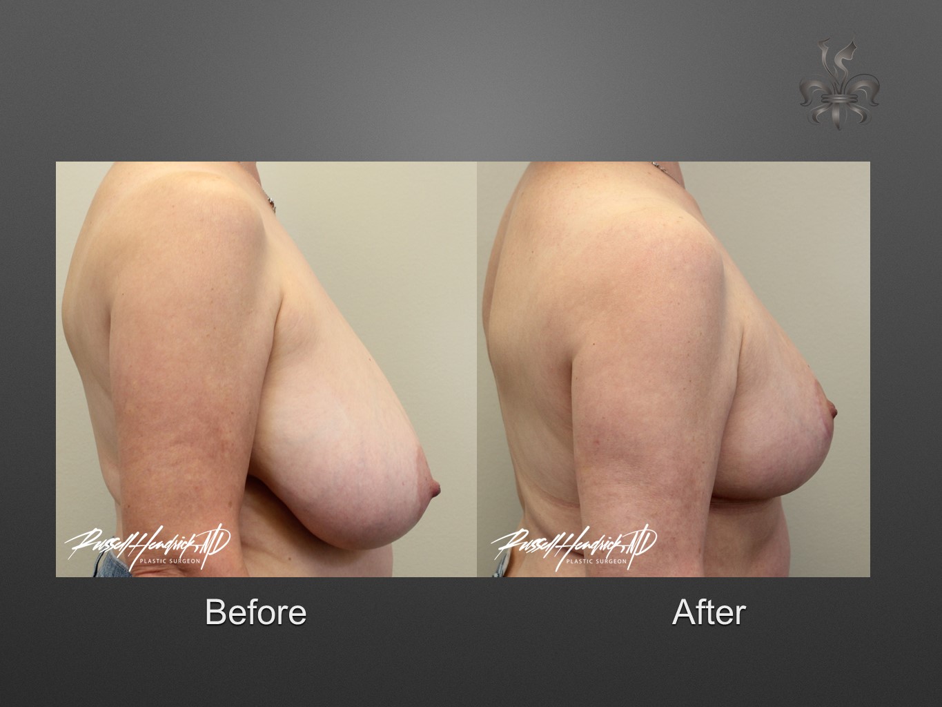 breast reduction before and after