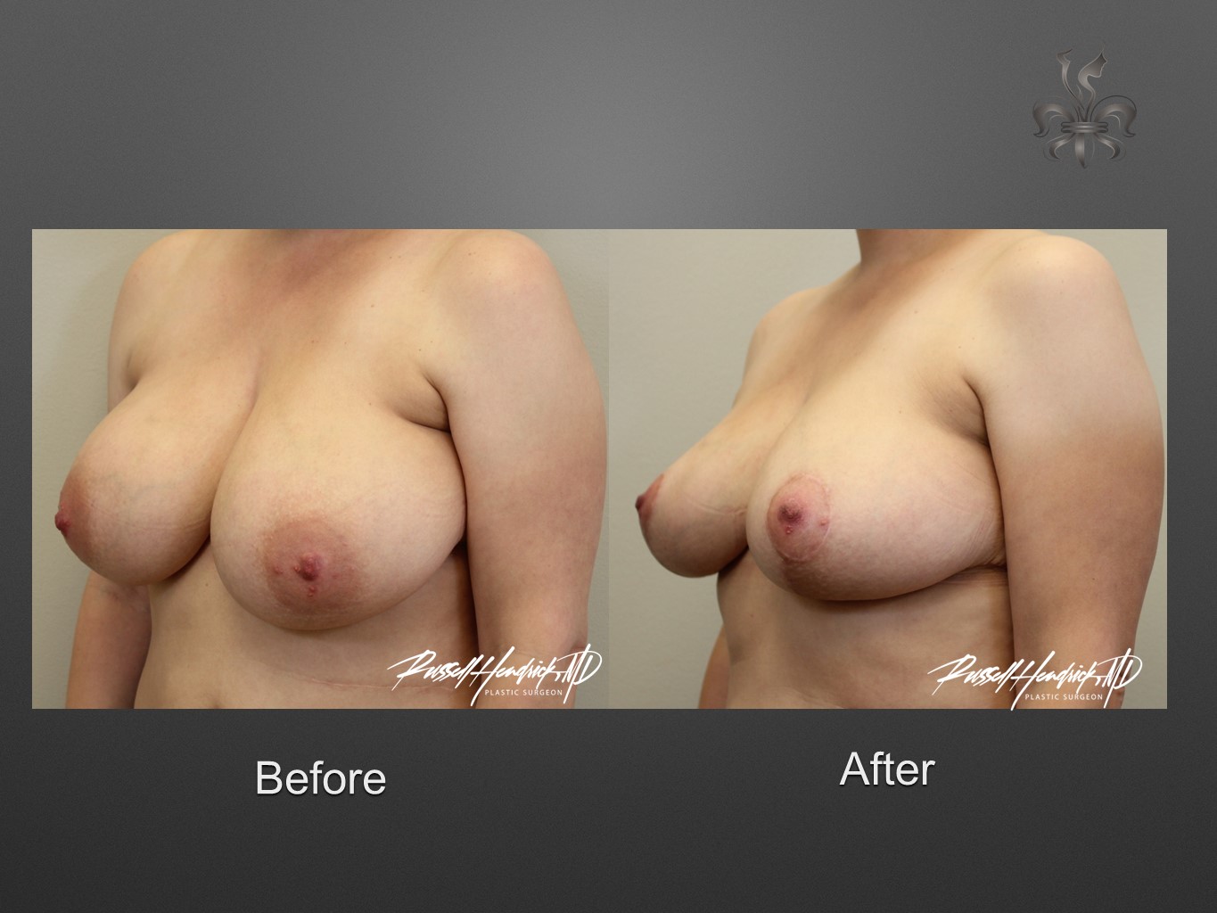 breast reduction before and after