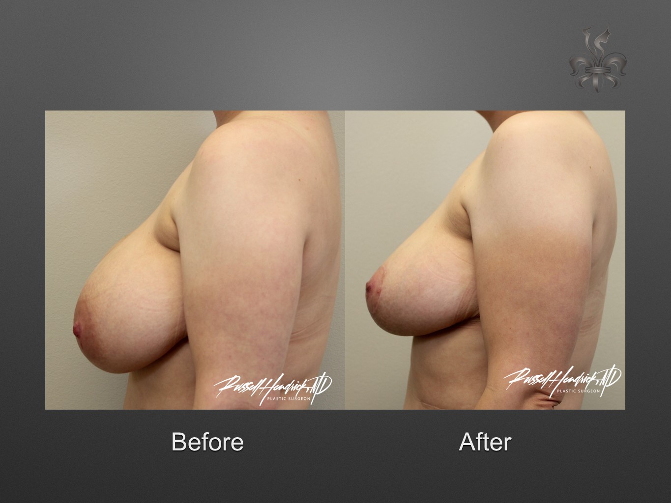 breast reduction before and after