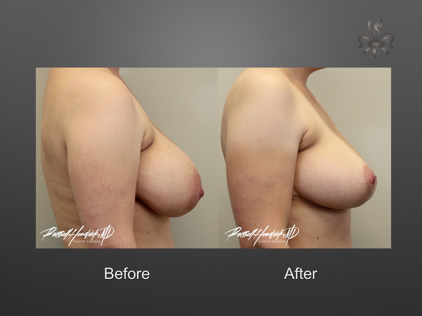 breast reduction before and after