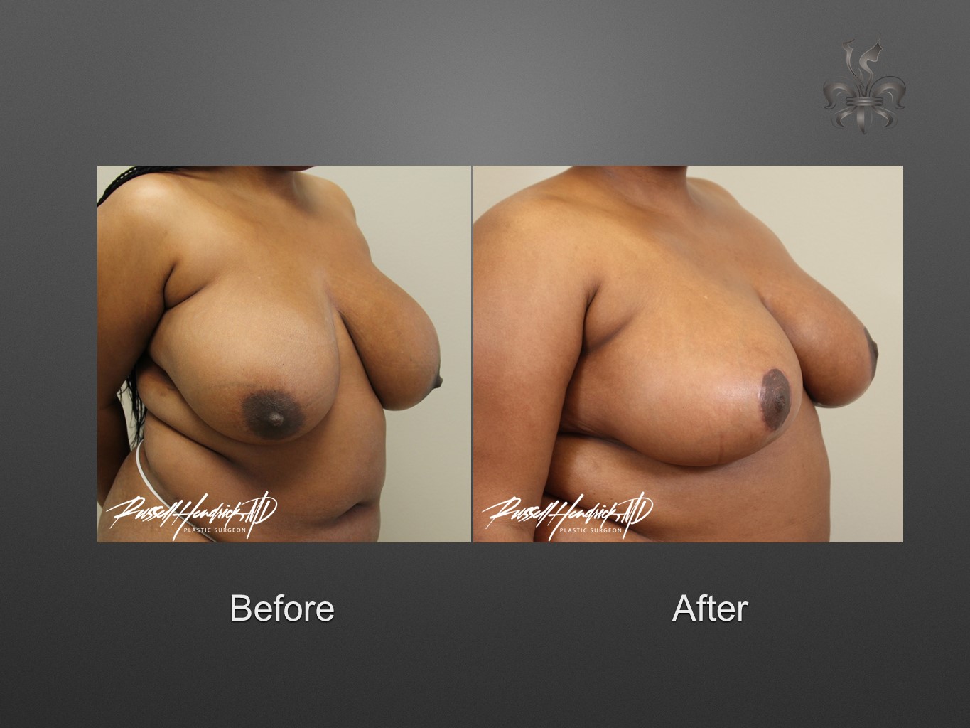 breast reduction before and after