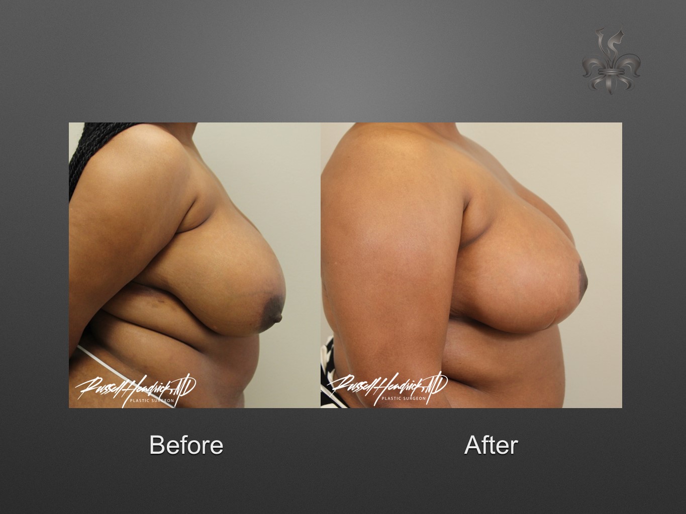 breast reduction before and after