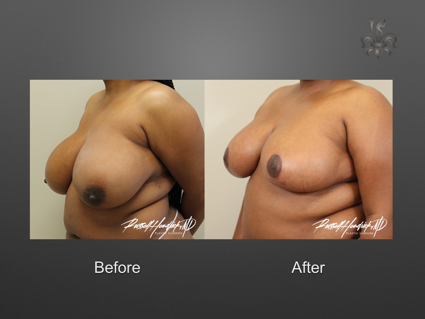 breast reduction before and after
