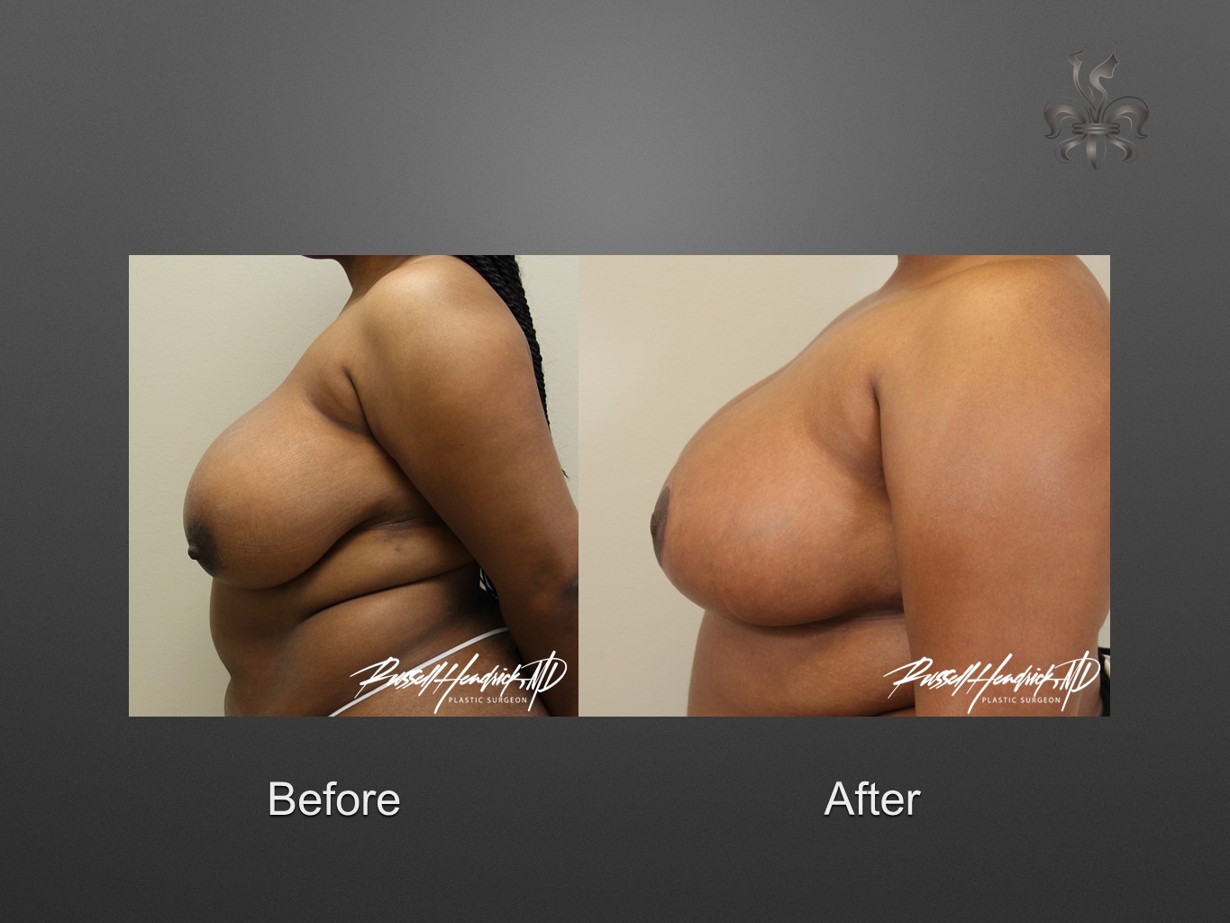 breast reduction before and after