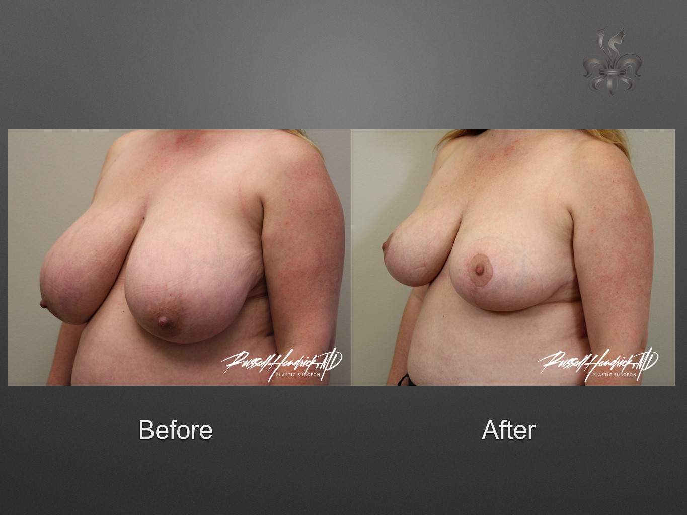 breast reduction before and after