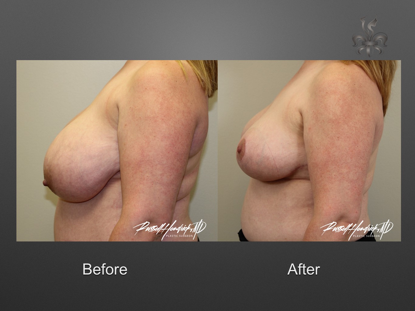 breast reduction before and after