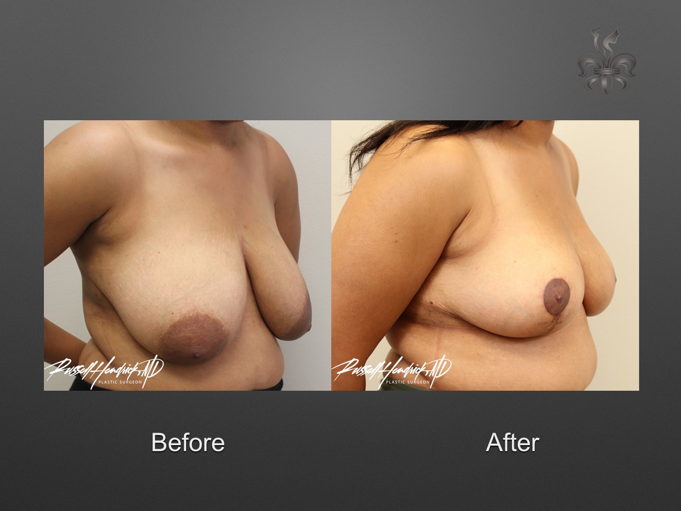 breast reduction before and after