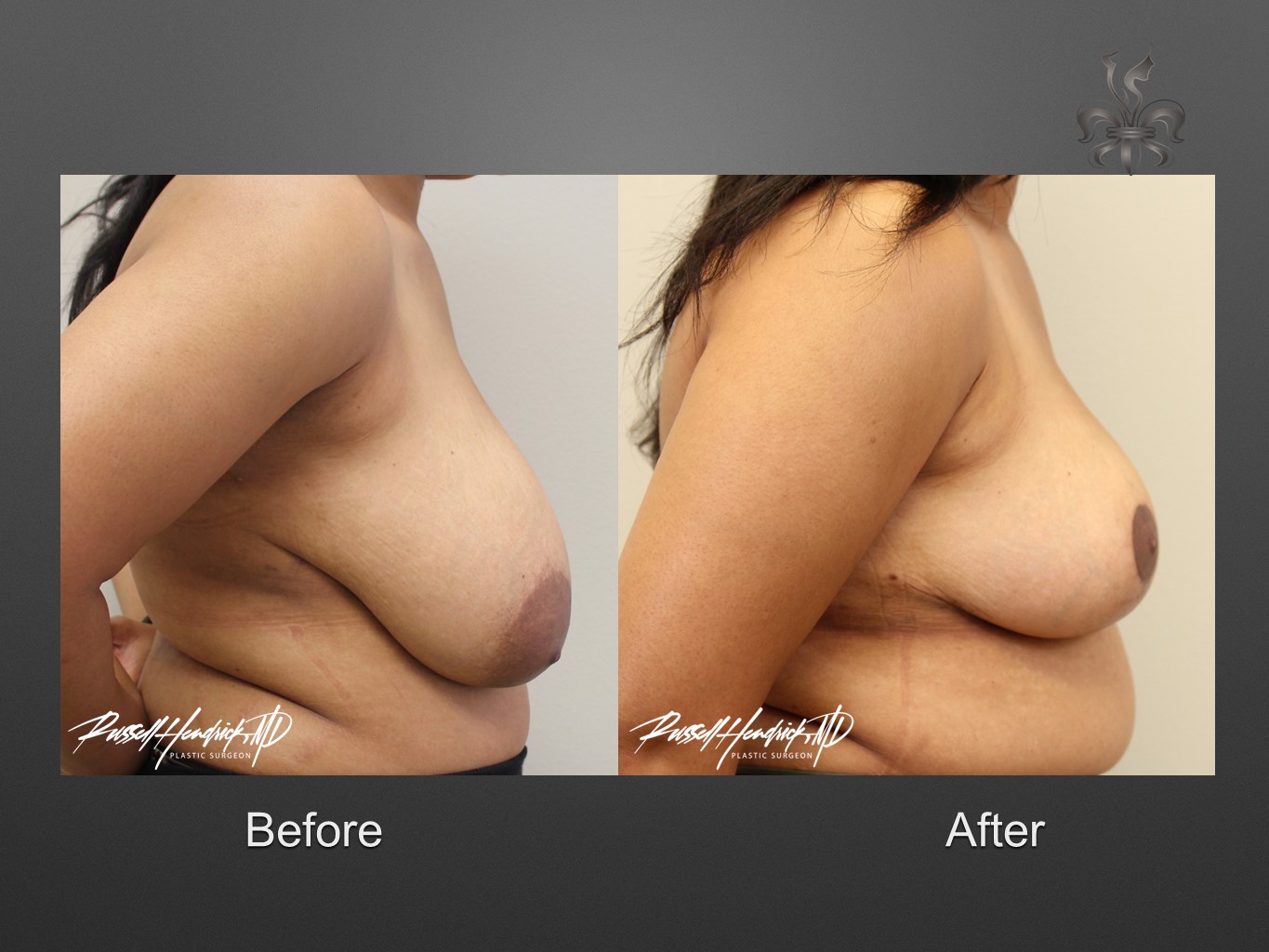 breast reduction before and after