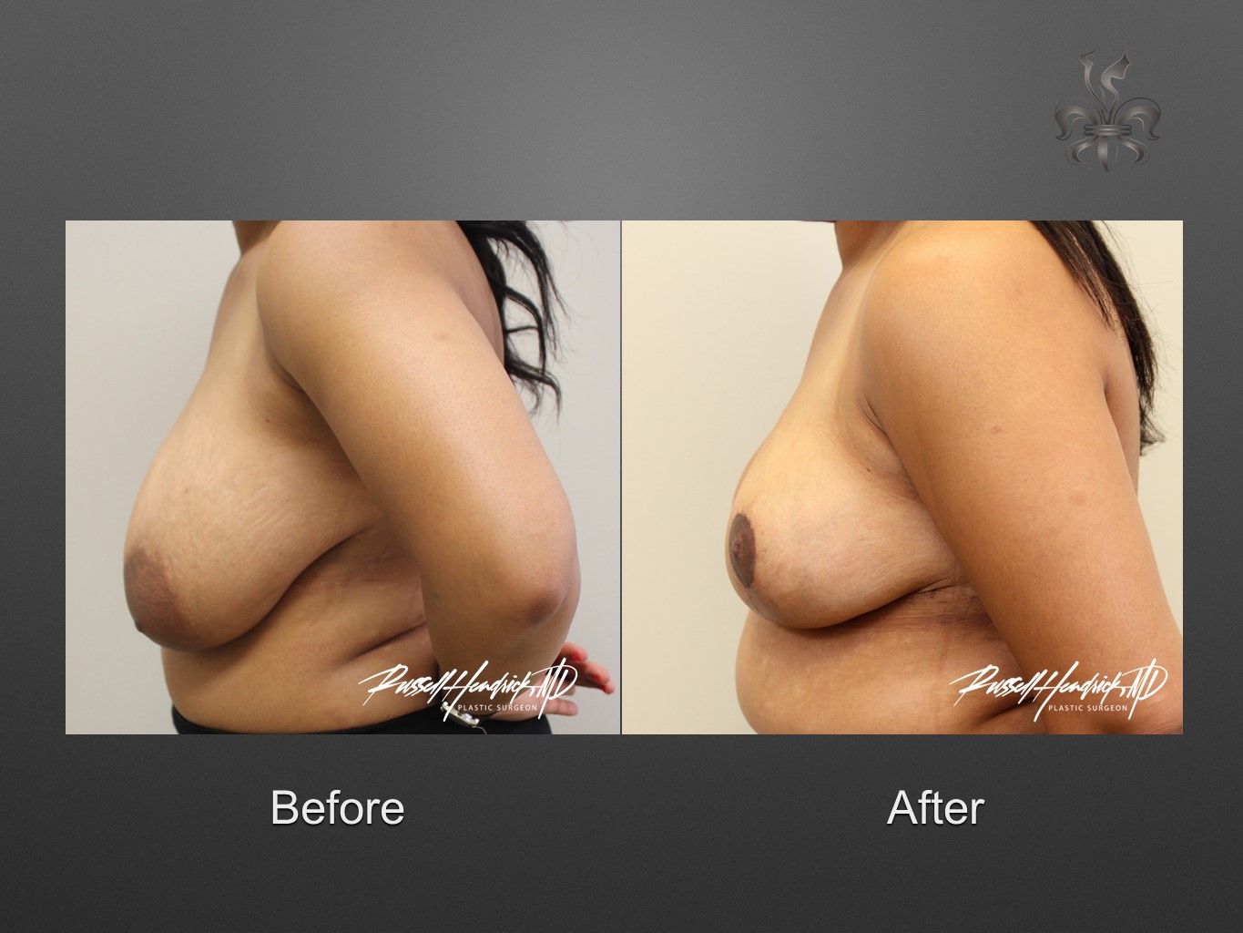 breast reduction before and after