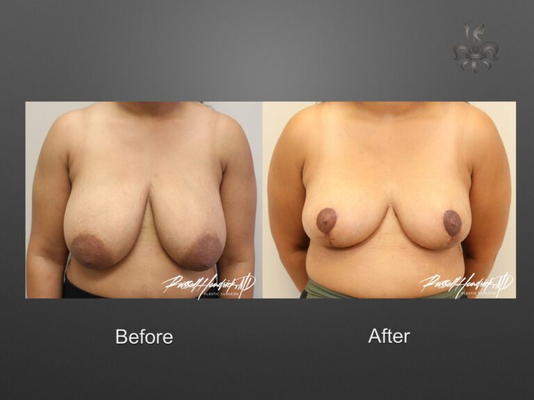 breast reduction before and after