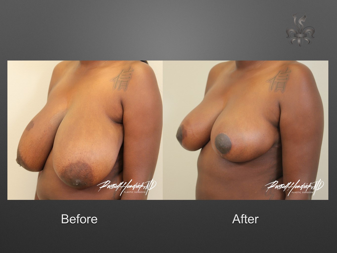 breast reduction before and after