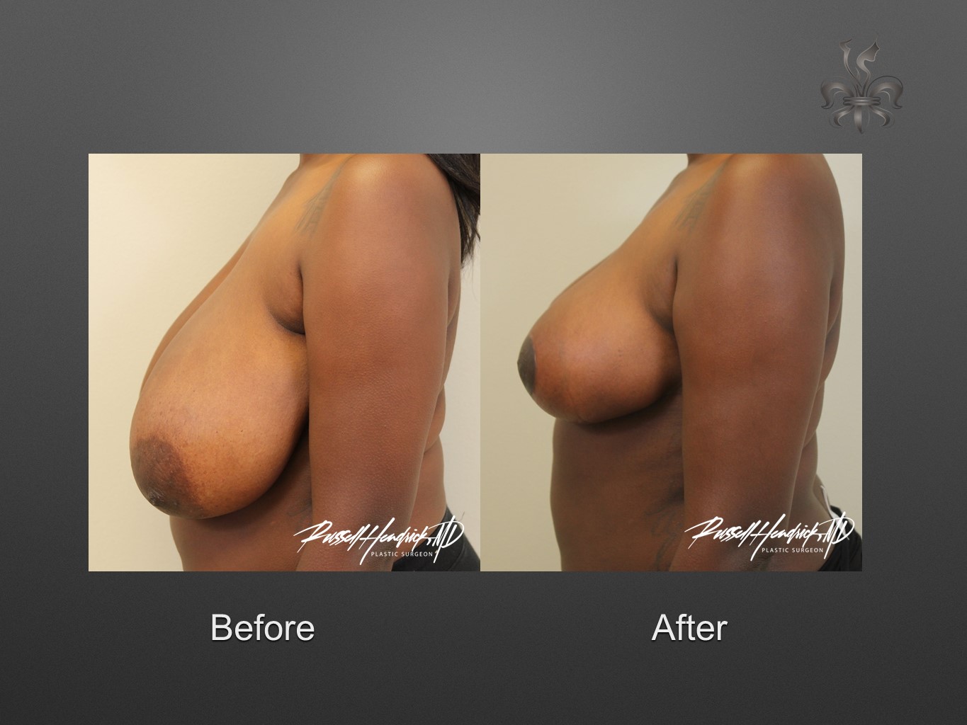 breast reduction before and after