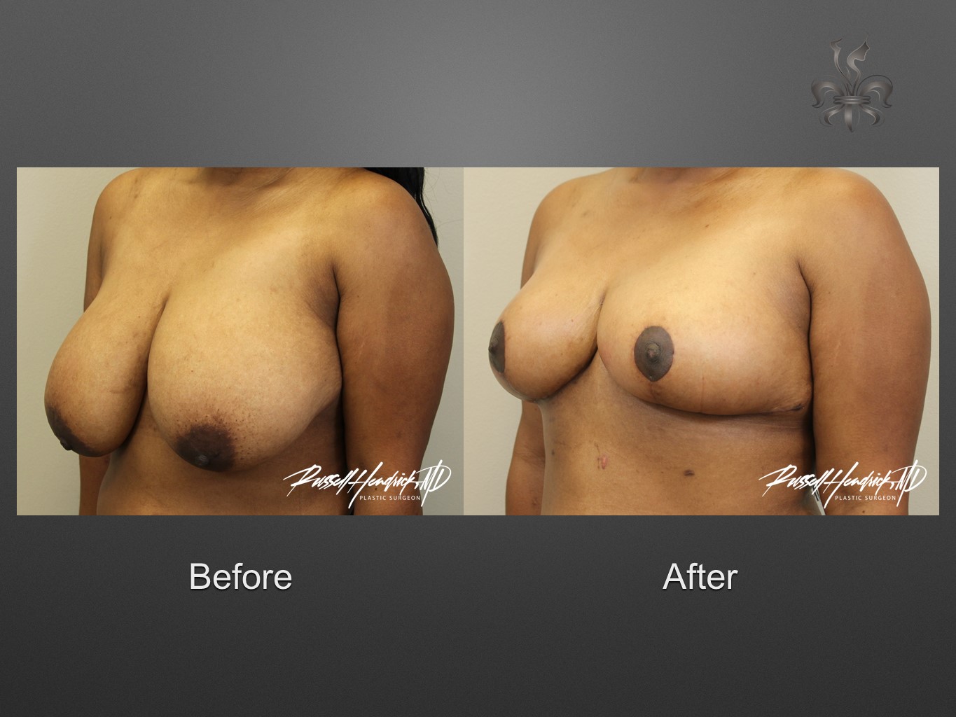 breast reduction before and after