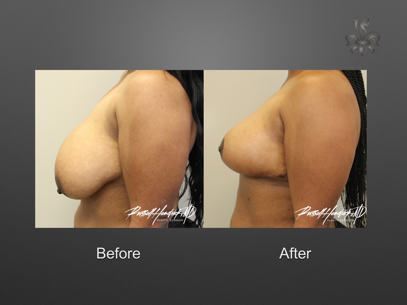breast reduction before and after