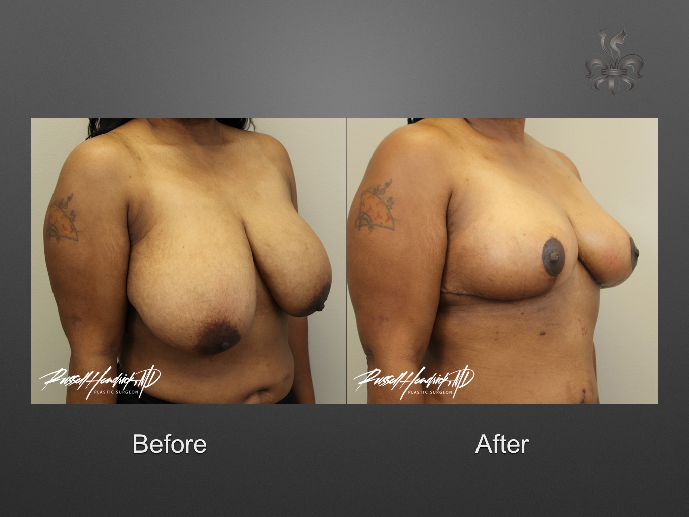breast reduction before and after