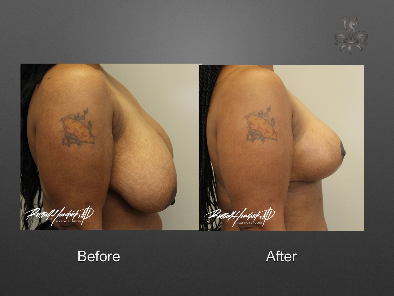 breast reduction before and after