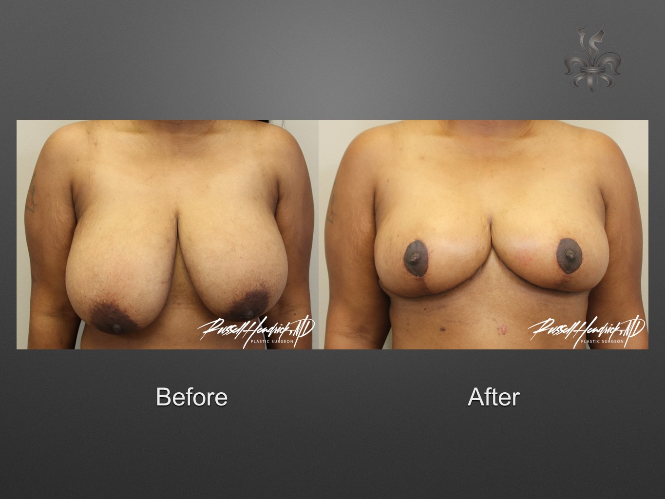 breast reduction before and after