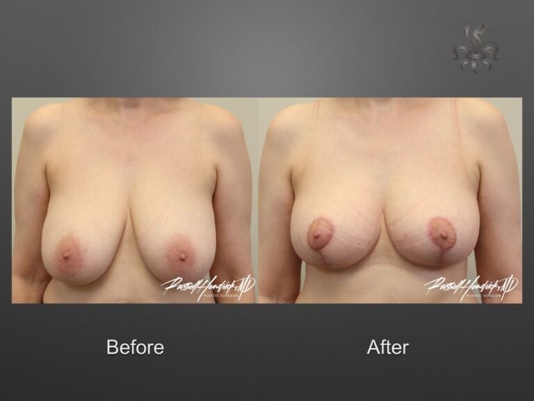 breast reduction before and after