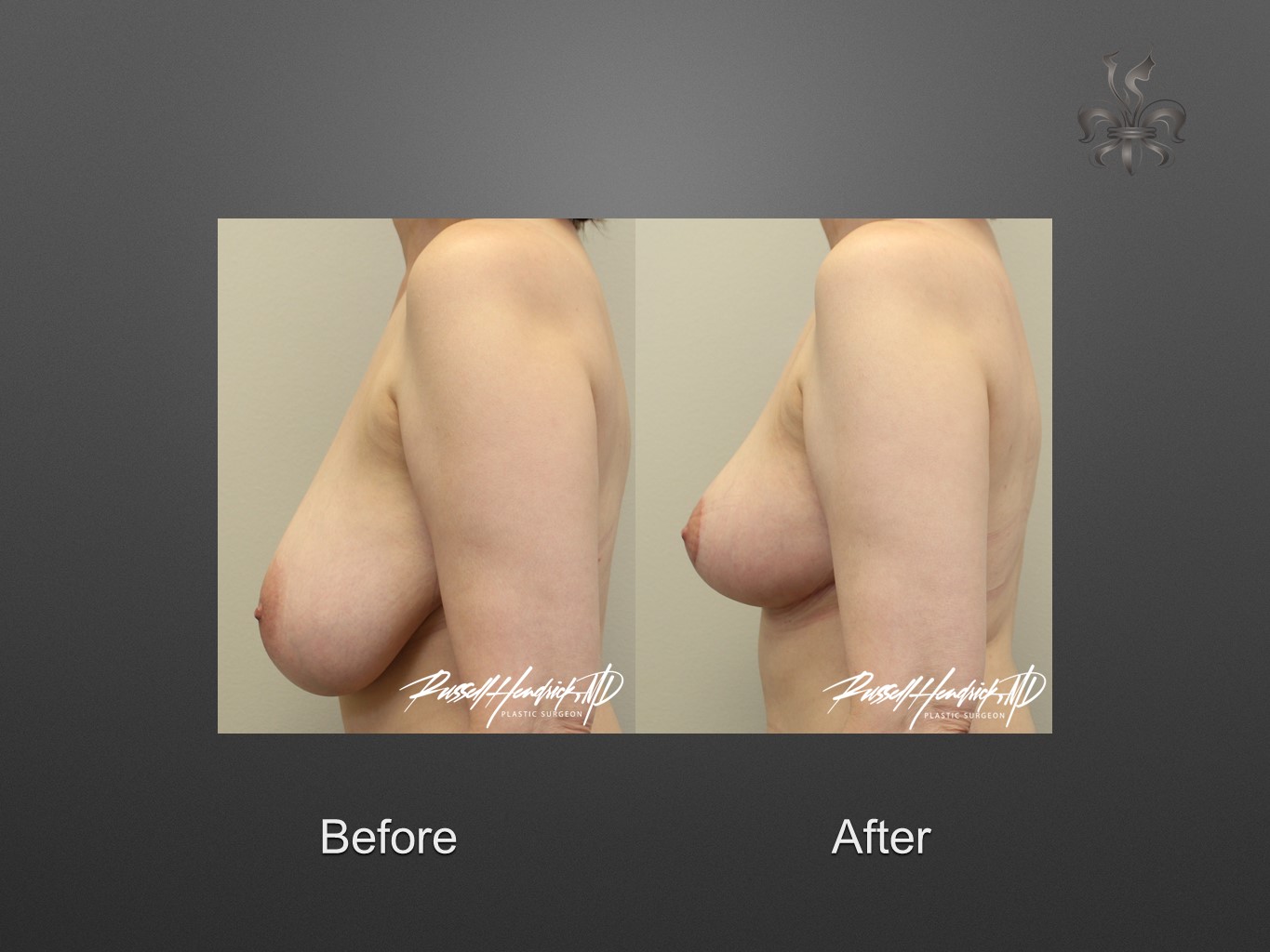 breast reduction before and after