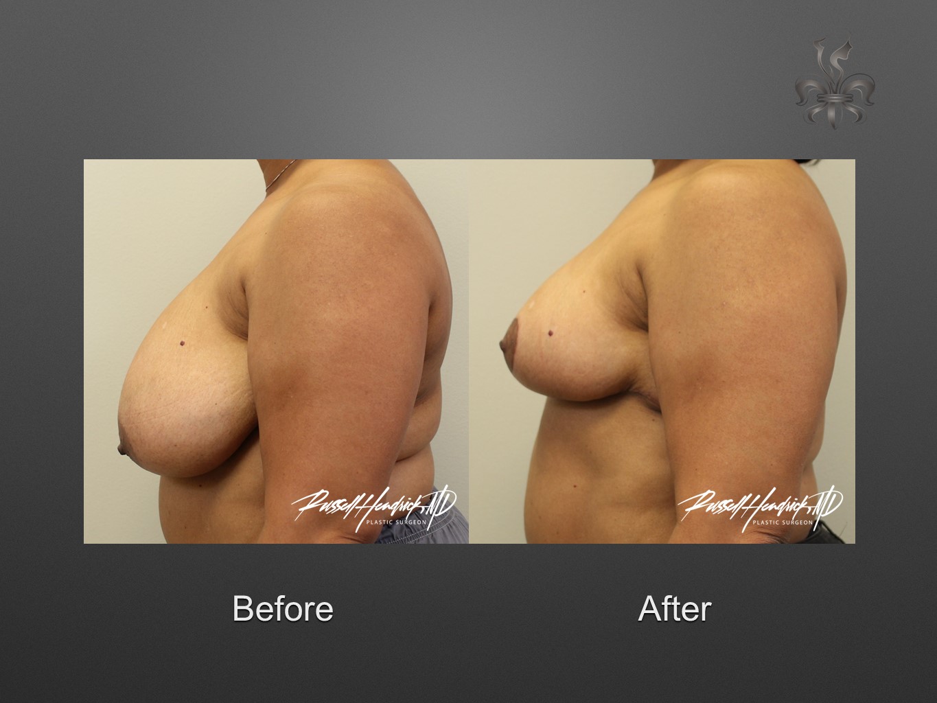 breast reduction before and after