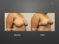 breast reduction before and after