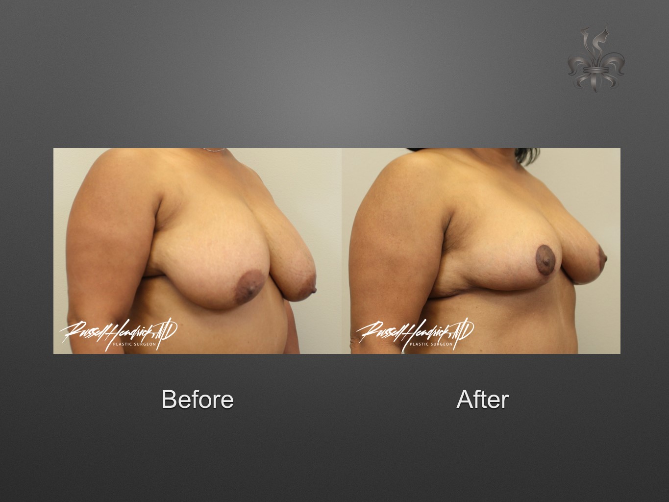 breast reduction before and after
