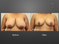 breast reduction before and after