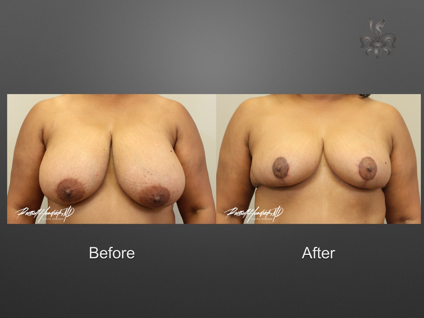 breast reduction before and after