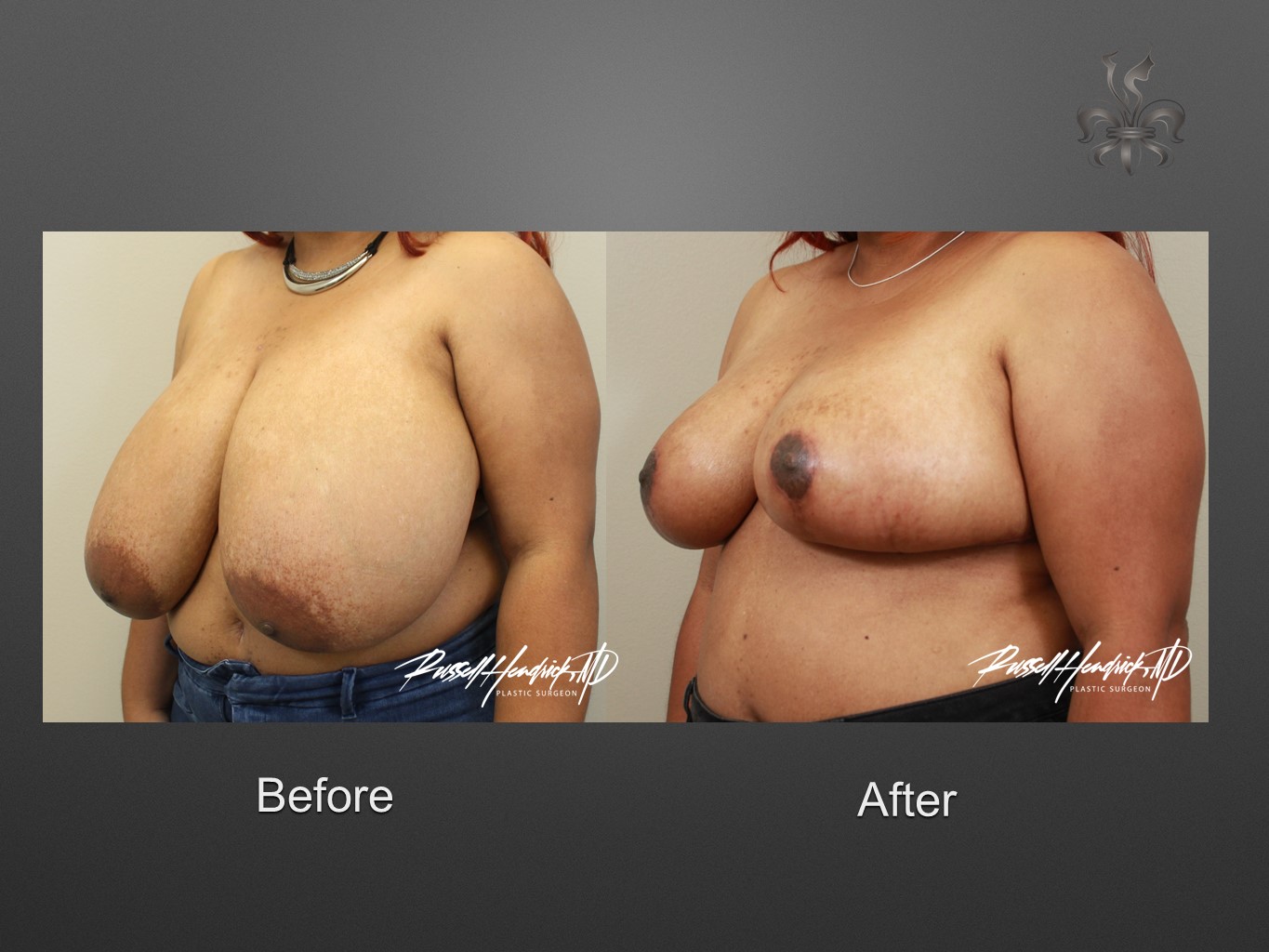 breast reduction before and after