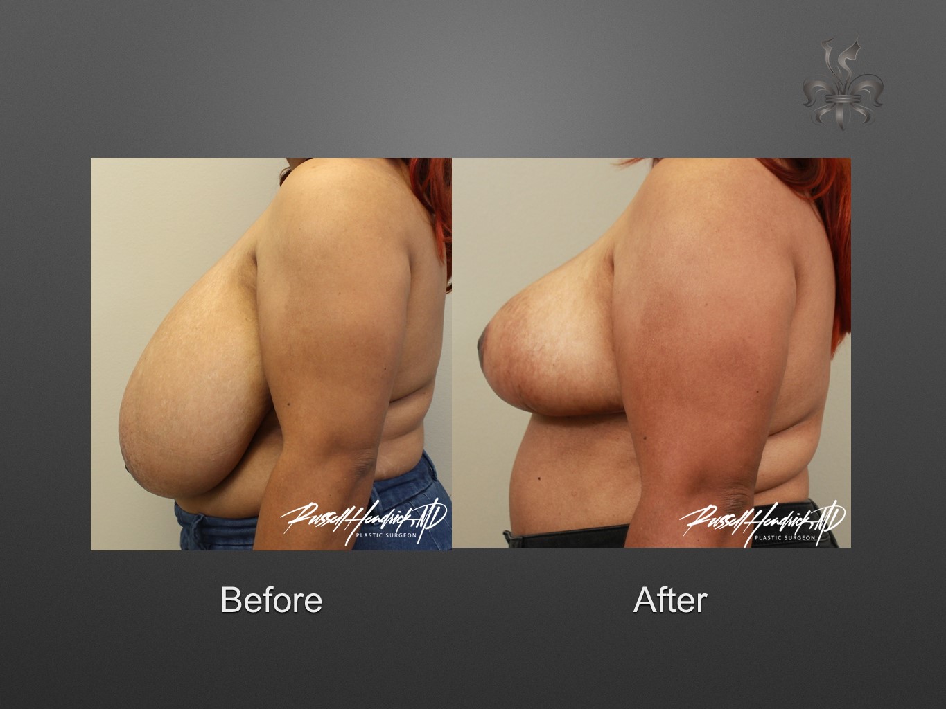 breast reduction before and after