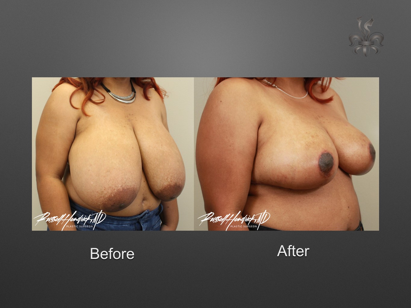 breast reduction before and after