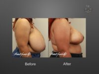 breast reduction before and after