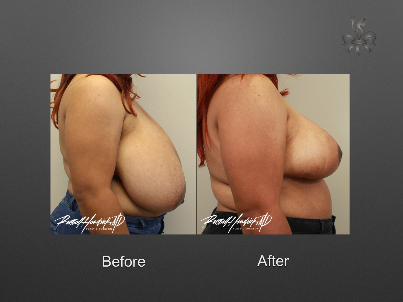 breast reduction before and after