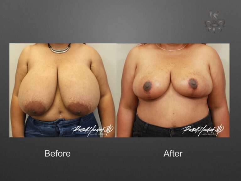 breast reduction before and after