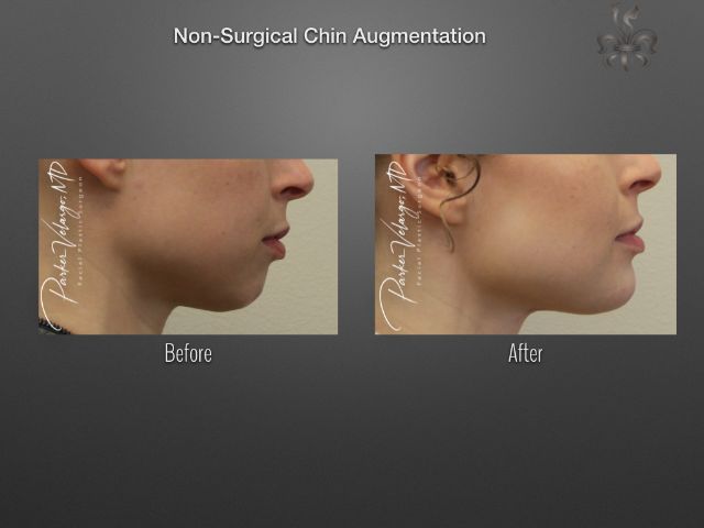 chin augmentation before and after