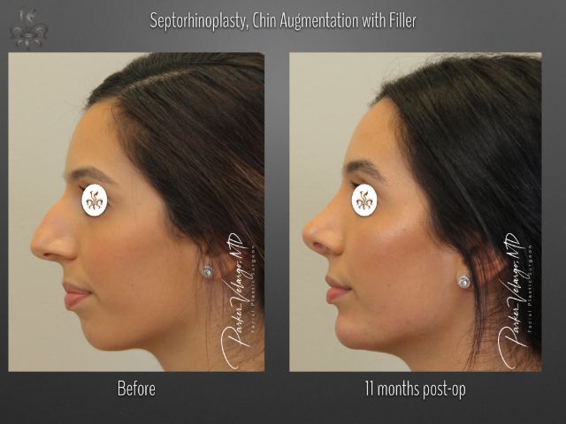 chin augmentation before and after