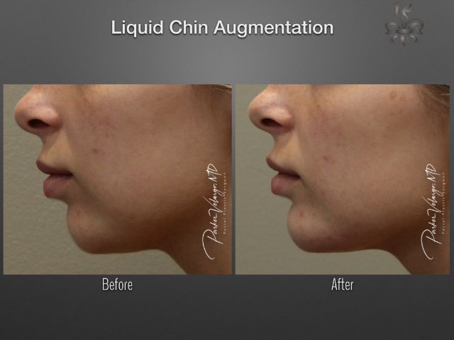 chin augmentation before and after