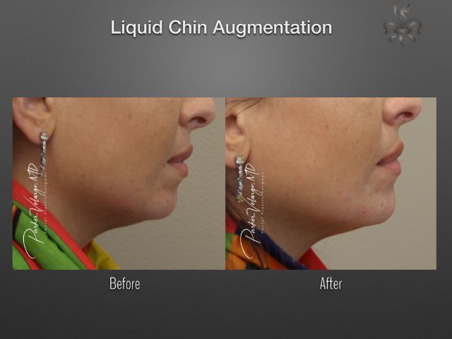 chin augmentation before and after