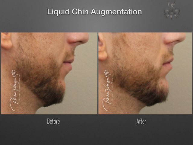 chin augmentation before and after