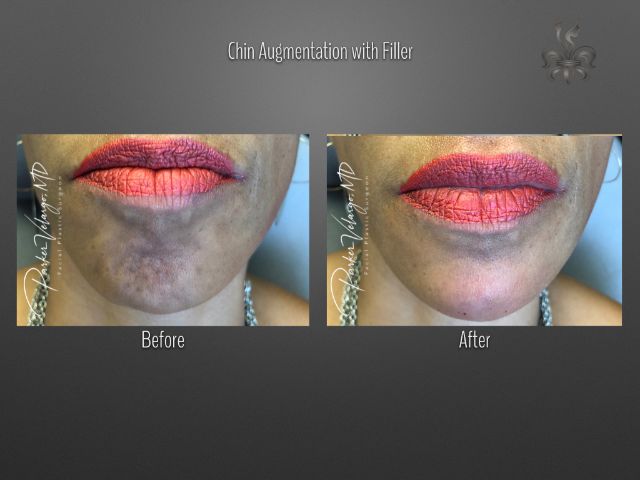 chin augmentation before and after
