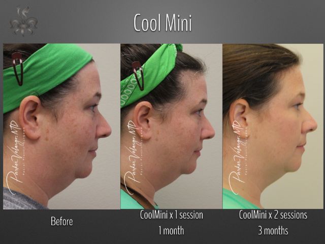 coolsculpting before and after