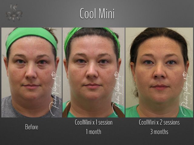 coolsculpting before and after