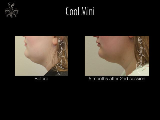 coolsculpting before and after