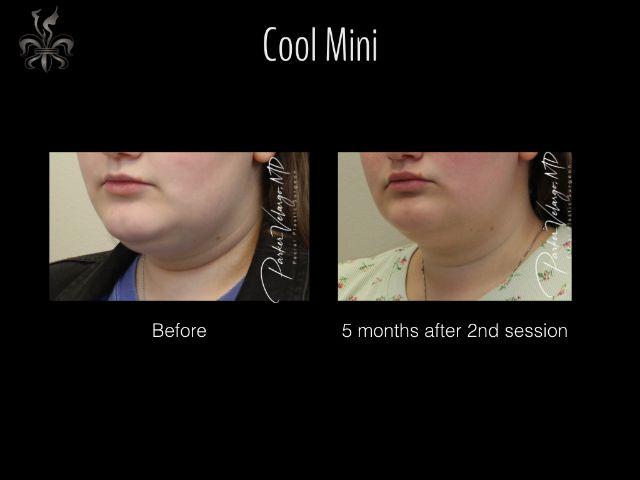 coolsculpting before and after