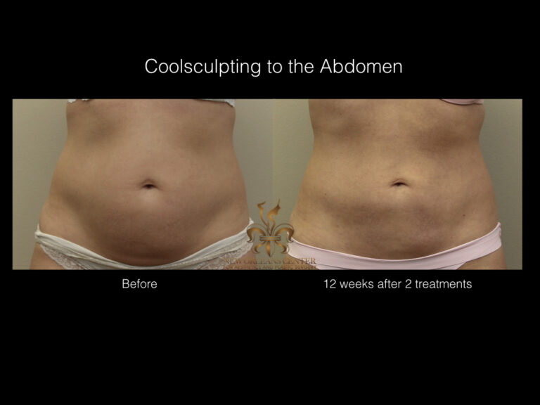 CoolSculpting before and after
