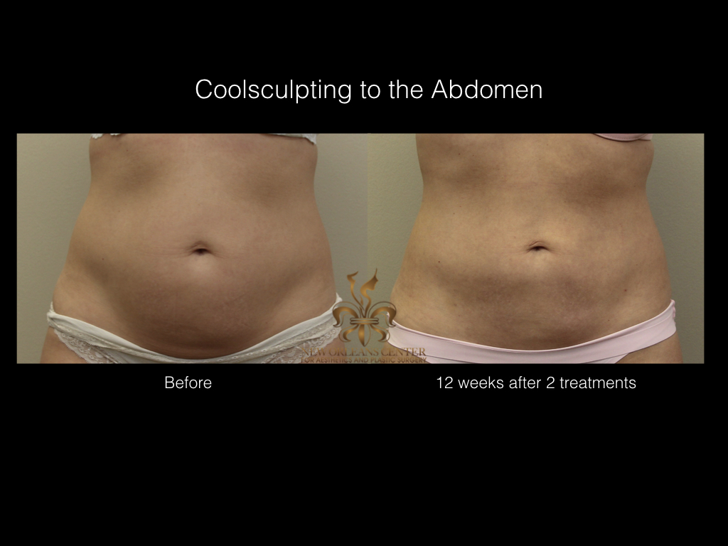 CoolSculpting before and after
