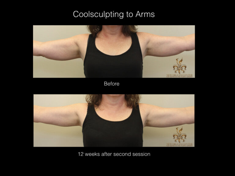 CoolSculpting before and after