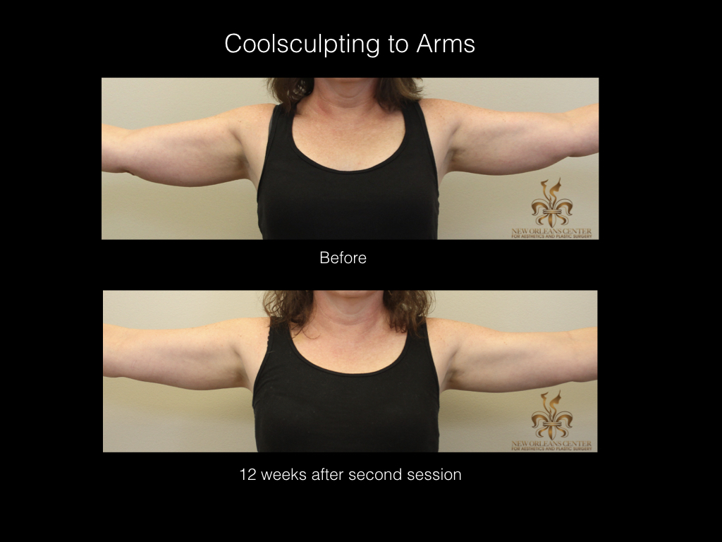 CoolSculpting before and after